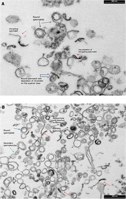 Ultrastructural Sperm Flagellum Defects in a Patient With CCDC39 Compound Heterozygous Mutations and Primary Ciliary Dyskinesia/Situs Viscerum Inversus